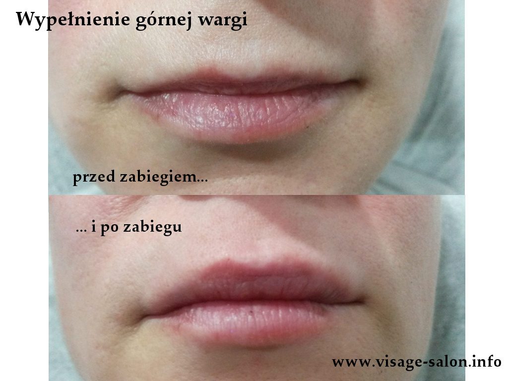 powiększanie ust wypełnianie warg kosmetyczka Kożuchów - salon Visage